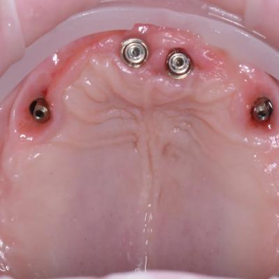 Protezuvannia Na Implantakh V004 001