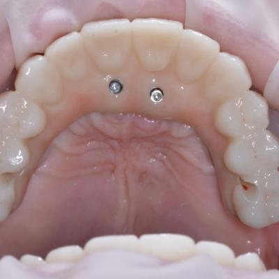 Protezuvannia Na Implantakh V004 002