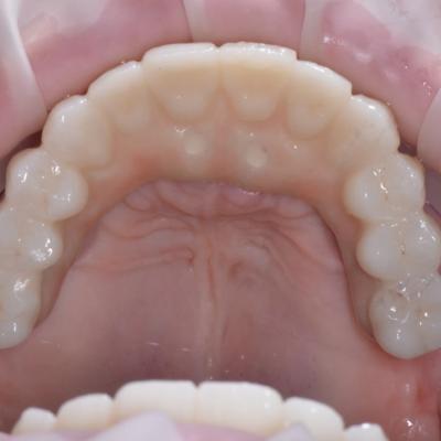 Protezuvannia Na Implantakh V004 003