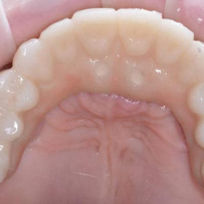 Protezuvannia Na Implantakh V004 004