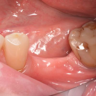 Protezuvannia Na Zubakh Ta Implantakh V004 001