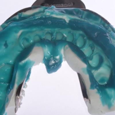 Protezuvannia Na Zubakh Ta Implantakh V004 002