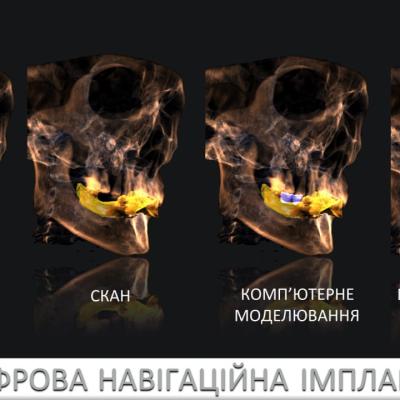 Protezuvannia Na Zubakh Ta Implantakh V004 004