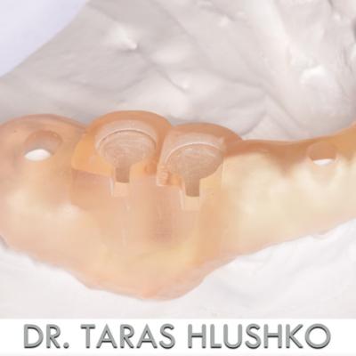 Protezuvannia Na Zubakh Ta Implantakh V004 005