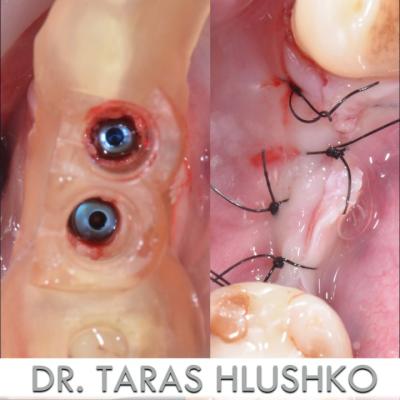 Protezuvannia Na Zubakh Ta Implantakh V004 008