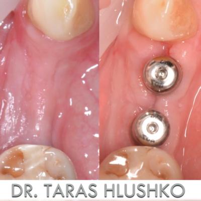 Protezuvannia Na Zubakh Ta Implantakh V004 010