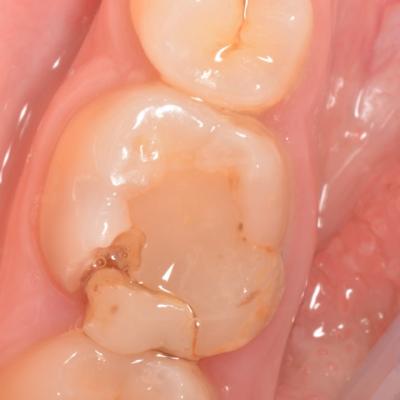 Protezuvannia Na Zubakh V005 I002