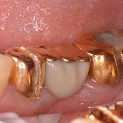 Protezuvannia Na Zubakh V006 I002