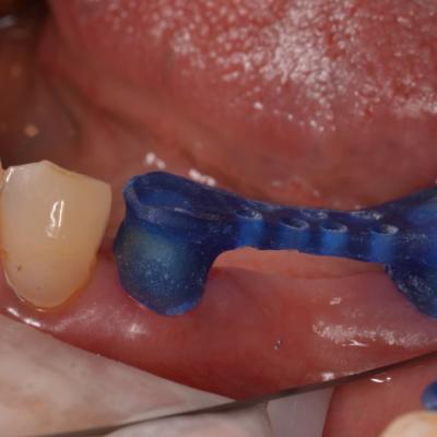 Protezuvannia Na Zubakh V006 I003