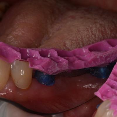 Protezuvannia Na Zubakh V006 I004