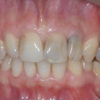 Protezuvannia Na Zubakh V007 I002