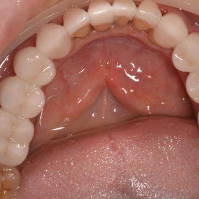 Protezuvannia Na Zubakh V008 002