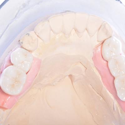 Protezuvannia Na Implantakh V5 I1