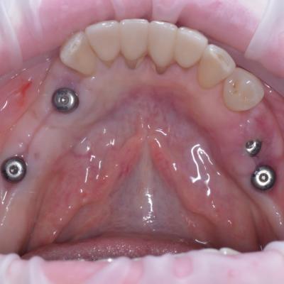 Protezuvannia Na Implantakh V5 I2