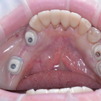 Protezuvannia Na Implantakh V5 I3