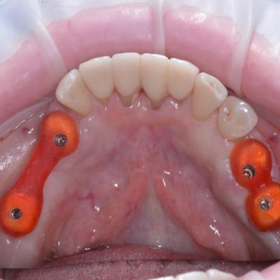 Protezuvannia Na Implantakh V5 I4