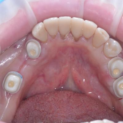 Protezuvannia Na Implantakh V5 I5