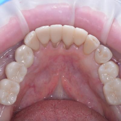 Protezuvannia Na Implantakh V5 I6