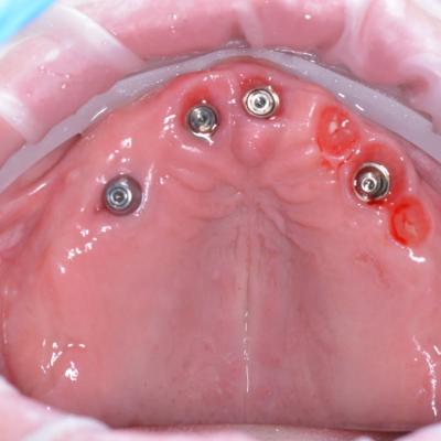 Protezuvannia Na Implantakh V6 I1