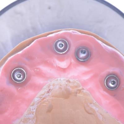 Protezuvannia Na Implantakh V6 I2