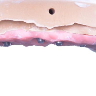 Protezuvannia Na Implantakh V6 I4