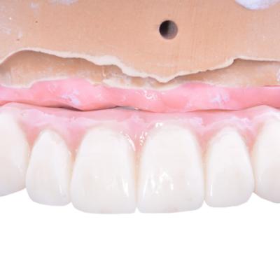 Protezuvannia Na Implantakh V6 I5