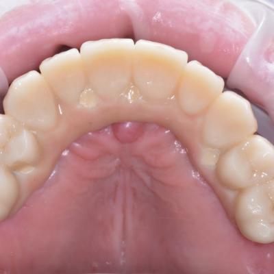 Protezuvannia Na Implantakh V6 I6