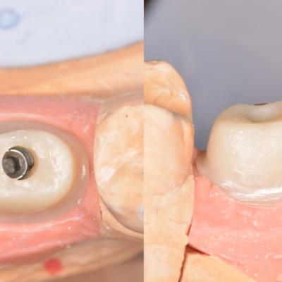 Protezuvannia Na Implantakh V7 I10