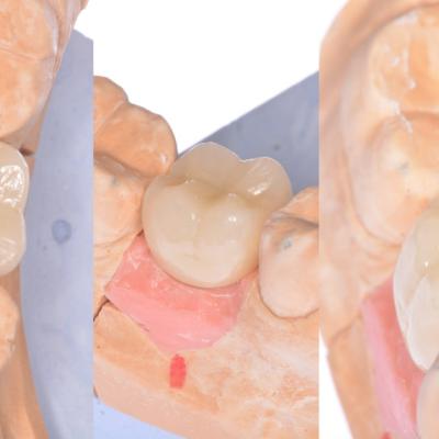 Protezuvannia Na Implantakh V7 I11