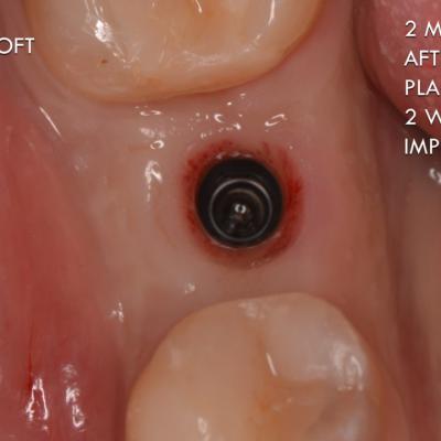 Protezuvannia Na Implantakh V7 I12