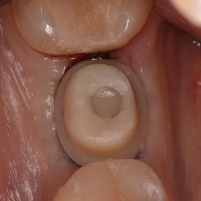 Protezuvannia Na Implantakh V7 I13