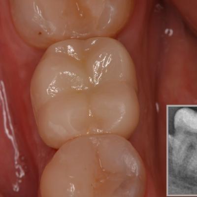 Protezuvannia Na Implantakh V7 I14