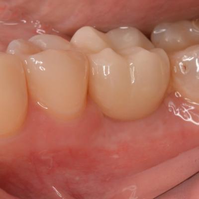 Protezuvannia Na Implantakh V7 I15