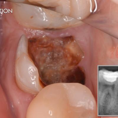 Protezuvannia Na Implantakh V7 I1