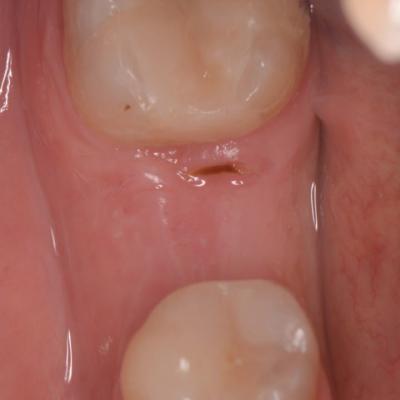 Protezuvannia Na Implantakh V7 I2