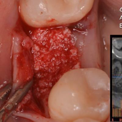 Protezuvannia Na Implantakh V7 I3