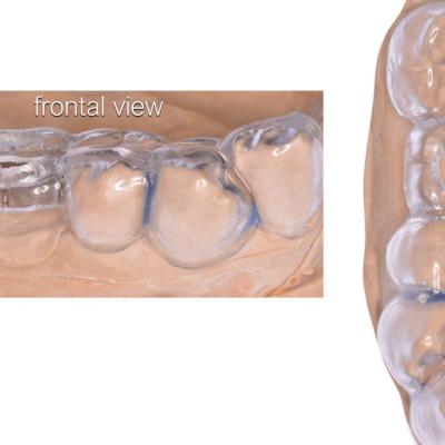 Protezuvannia Na Implantakh V7 I4
