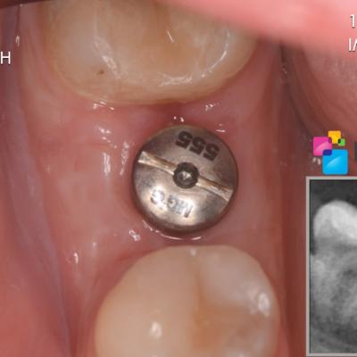 Protezuvannia Na Implantakh V7 I5
