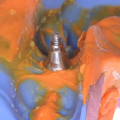 Protezuvannia Na Implantakh V7 I6