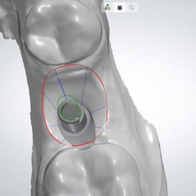 Protezuvannia Na Implantakh V7 I7