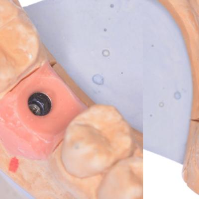 Protezuvannia Na Implantakh V7 I9