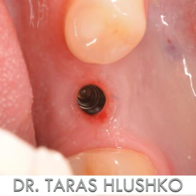 Protezuvannia Na Zubakh Ta Implantakh V5 I1