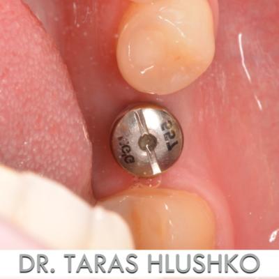 Protezuvannia Na Zubakh Ta Implantakh V5 I2