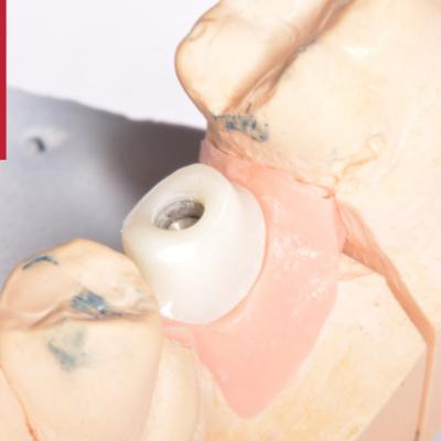 Protezuvannia Na Zubakh Ta Implantakh V5 I3