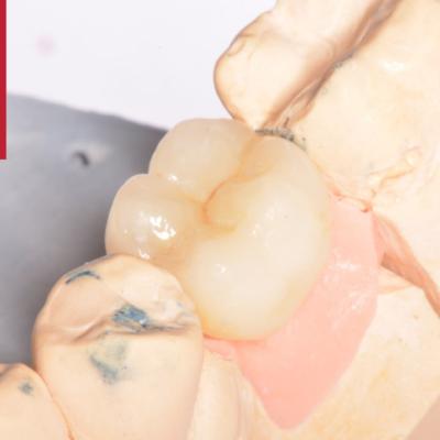 Protezuvannia Na Zubakh Ta Implantakh V5 I4