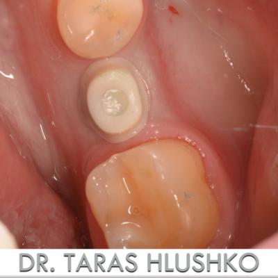 Protezuvannia Na Zubakh Ta Implantakh V5 I5