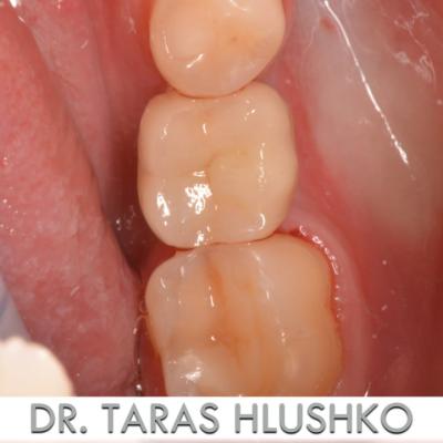 Protezuvannia Na Zubakh Ta Implantakh V5 I6