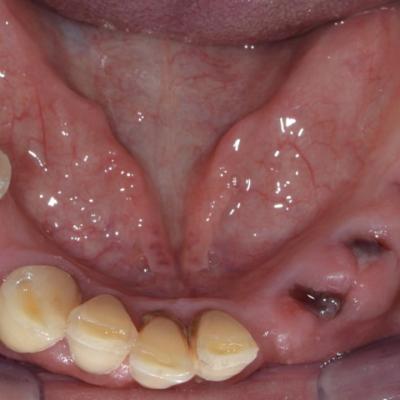 Protezuvannia Na Zubakh Ta Implantakh V6 I1