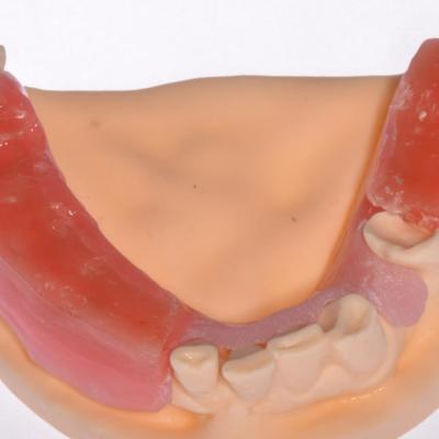 Protezuvannia Na Zubakh Ta Implantakh V6 I3