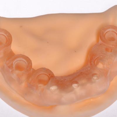 Protezuvannia Na Zubakh Ta Implantakh V6 I4